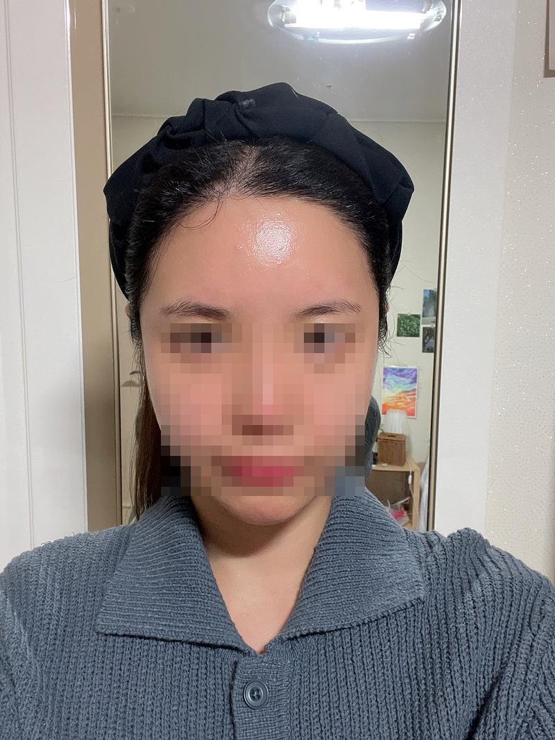 모모성형외과의원 비절개 모발이식 2370모 180일 경과 후기