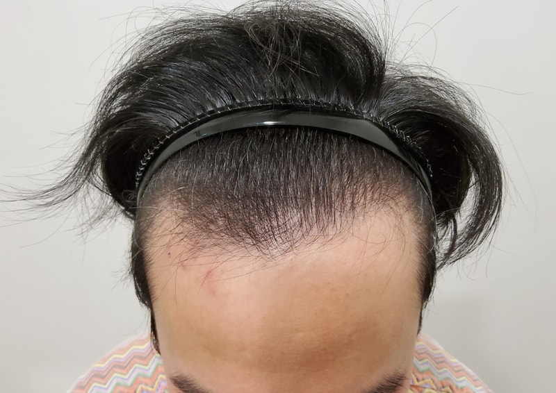 어제 모발이식 받고왔어요