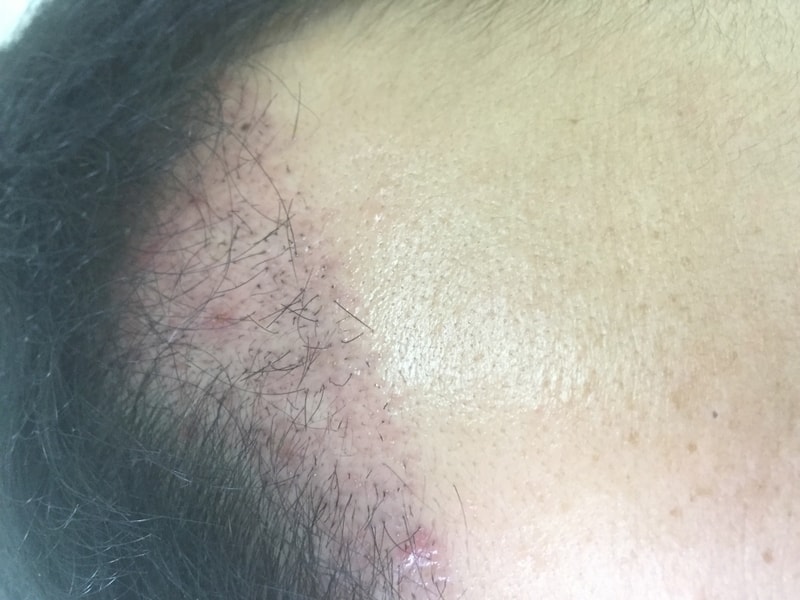 non-cut 1400 hair follicle (no cut)