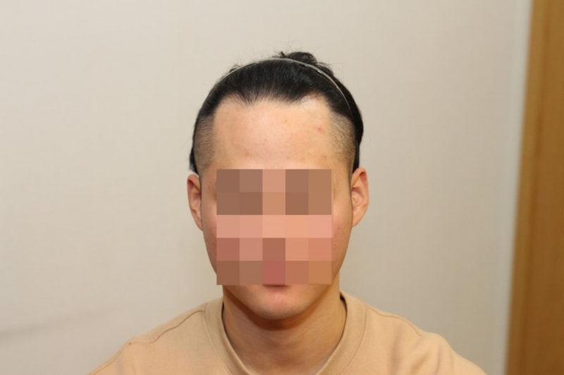 新发型毛发移植1年后的后记