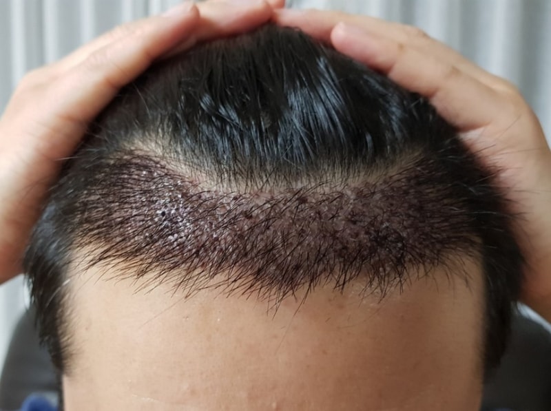 Surgical with an M-shaped 3,000 hair incision in New Hair.