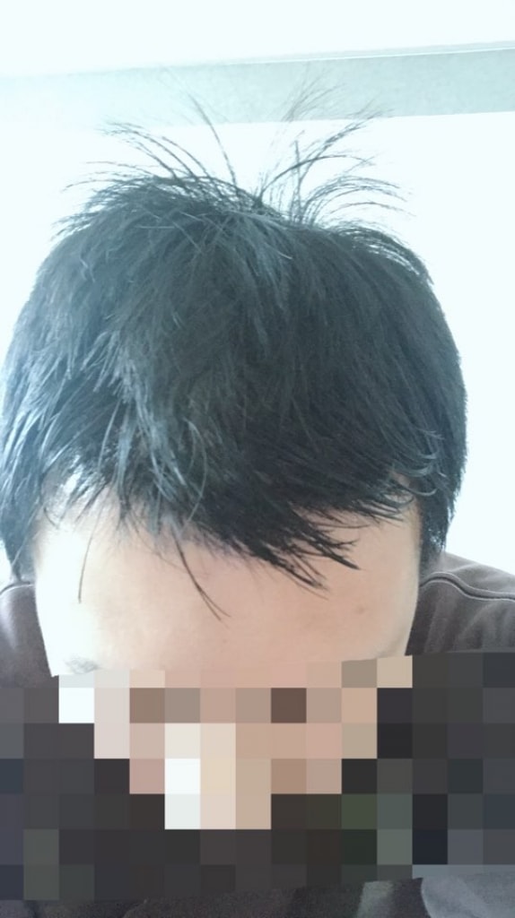 ニューヘアの手術レビューをアップします
