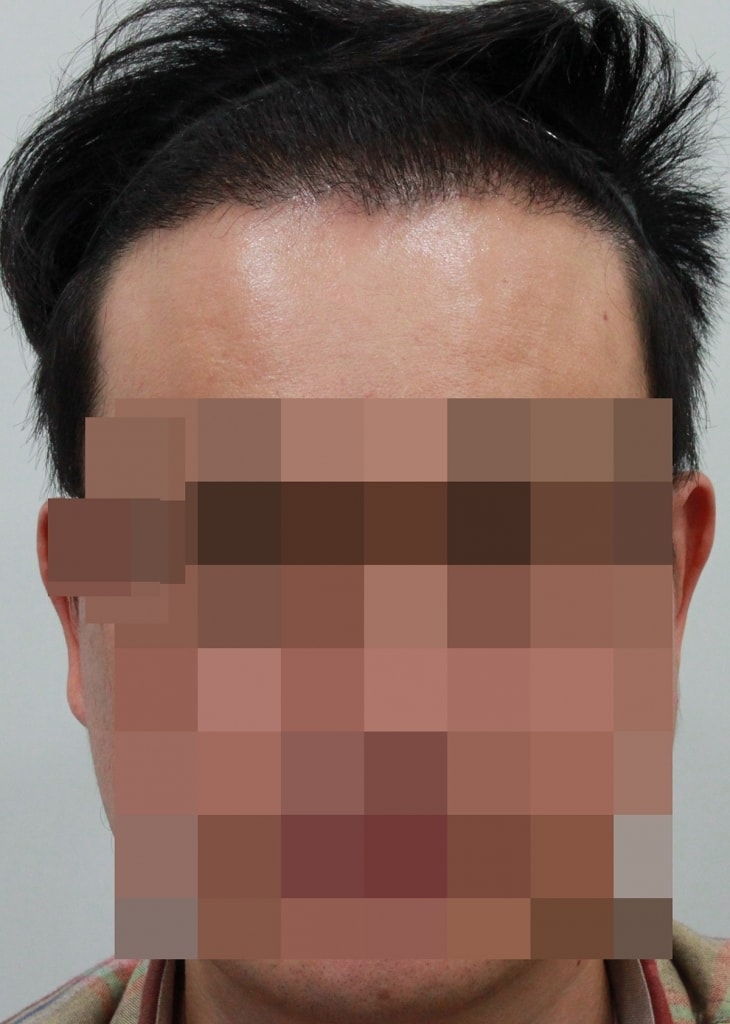 수술후_1.JPG