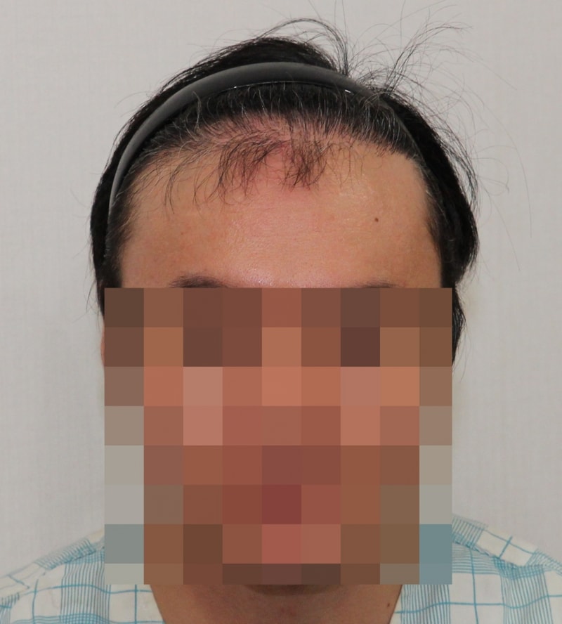 移植1300毛囊6个月，呼... 过关了