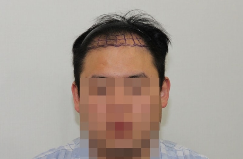 2000모낭 1년 모발이식후기입니다