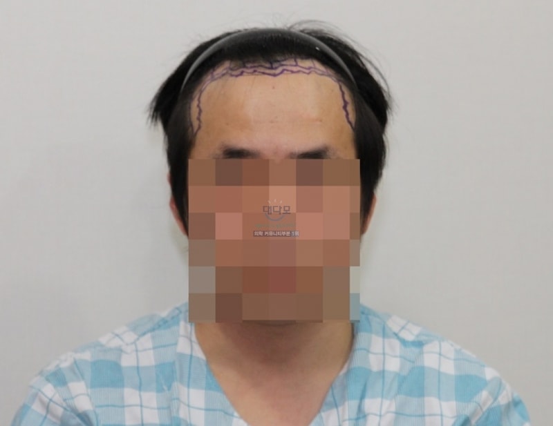 Hair transplant 1800 follicles + 1200 follicles secondary review.
