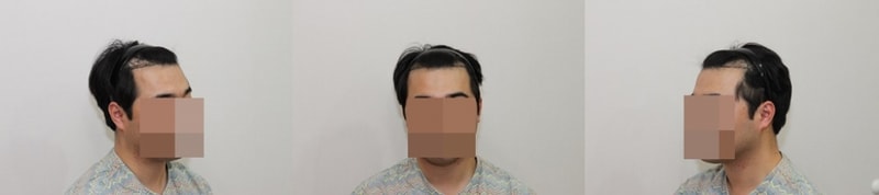 비절개슬릿 모발이식1300모낭... 6개월 넘겼습니다!