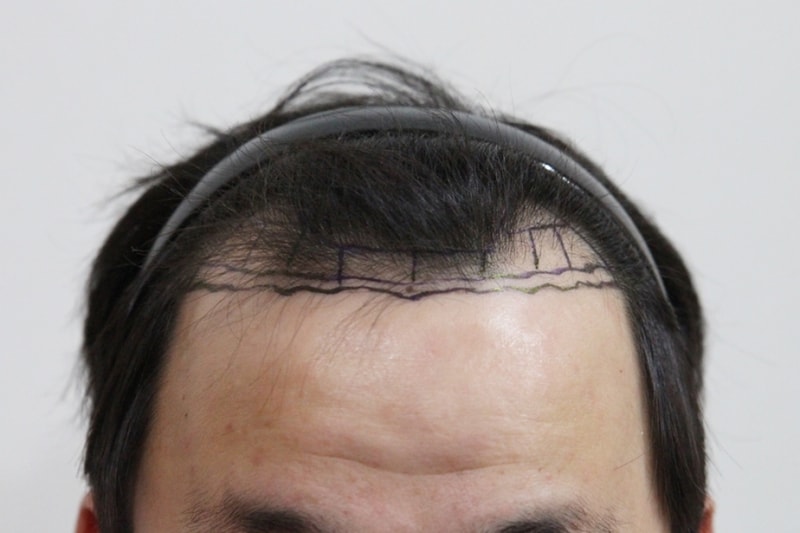 Non-cut/slit hair transplant surgery 1532 hair follicles 7 months later