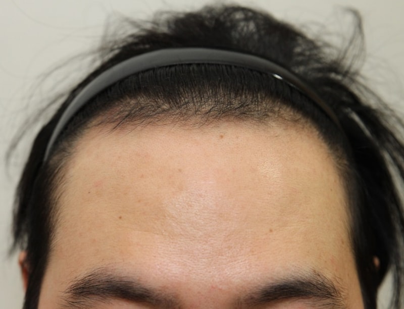 非切開 2000毛包 8ヵ月後記