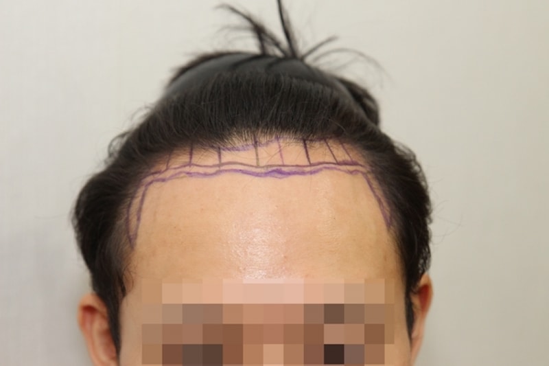 It's been almost a year since the non-cut 1,500 hair follicles