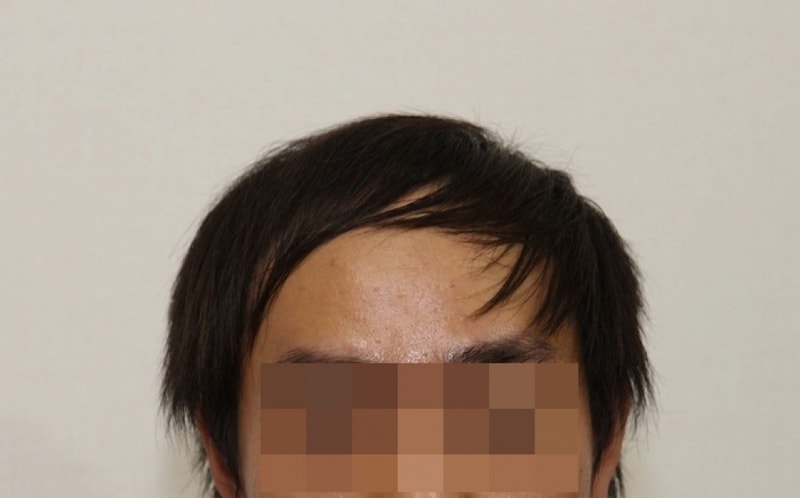 My hair is growing well in my 6th month of hair follicle transplantation~!!
