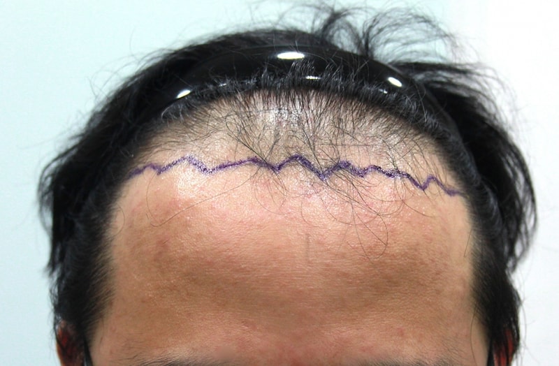 수술전디자인.jpg