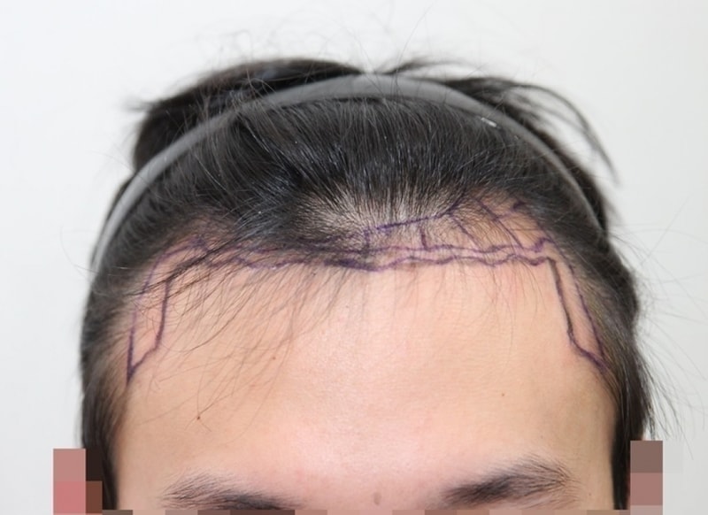 Hair transplant 1500 hair follicles for 6 months!