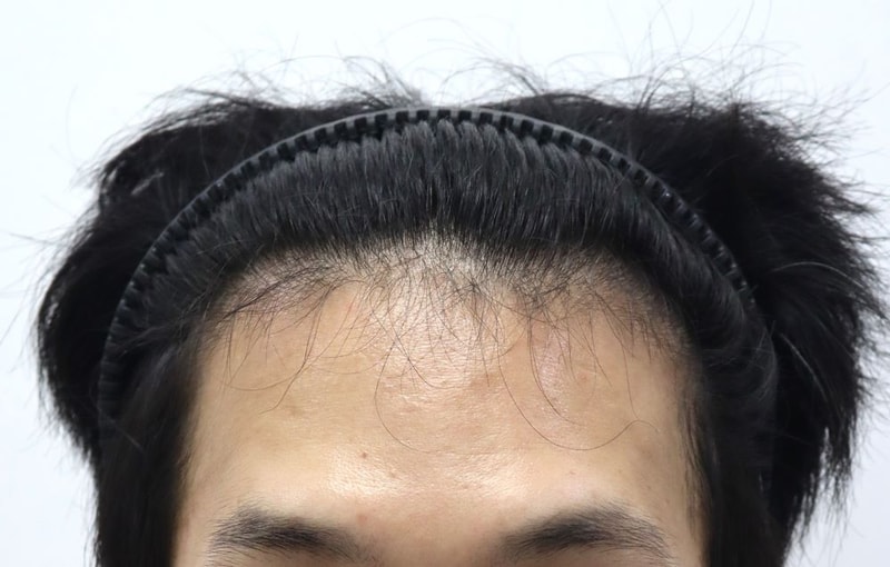 압구정 포헤어 넓은이마 비절개슬릿 모발이식 수술당일 후기 / 민영기 원장님
