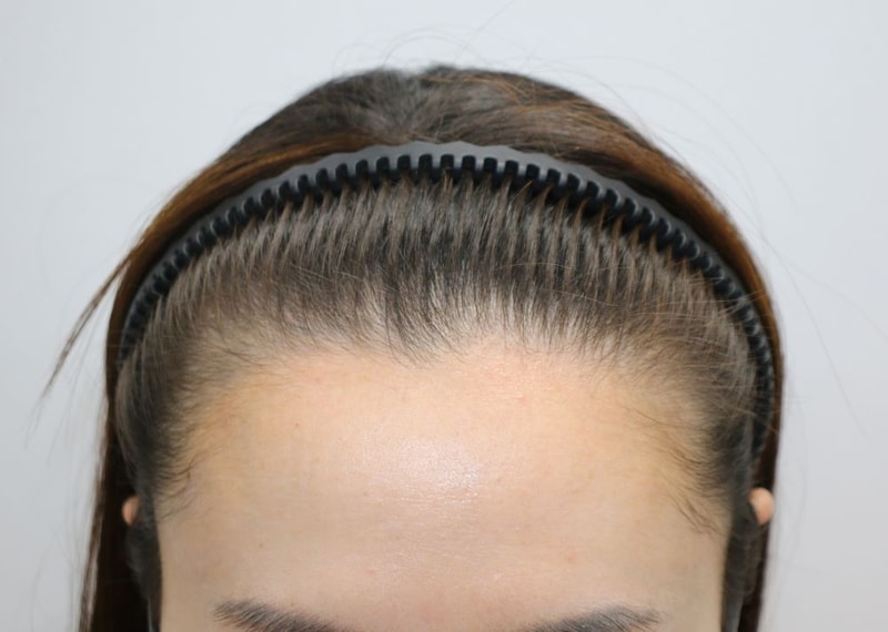 7 months of hair loss correction after giving birth to Gangnam Pohair Non-cut Hair Transplantation