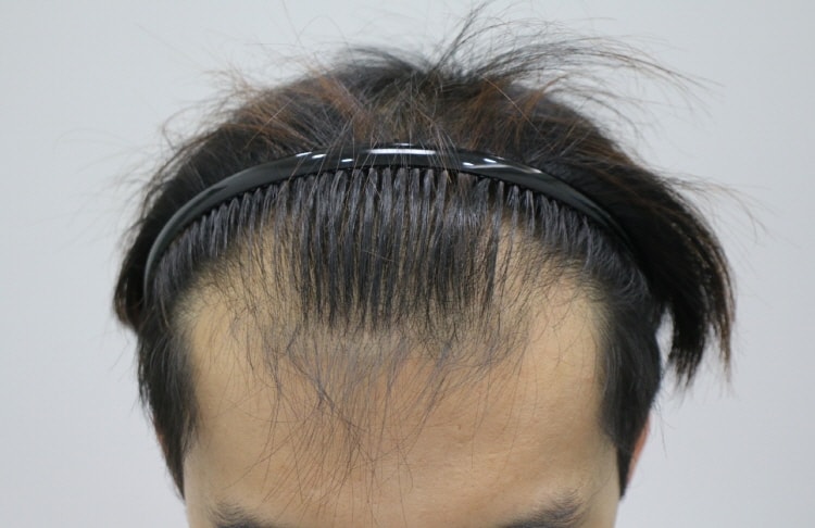 5个月做马尾手术 2000毛囊