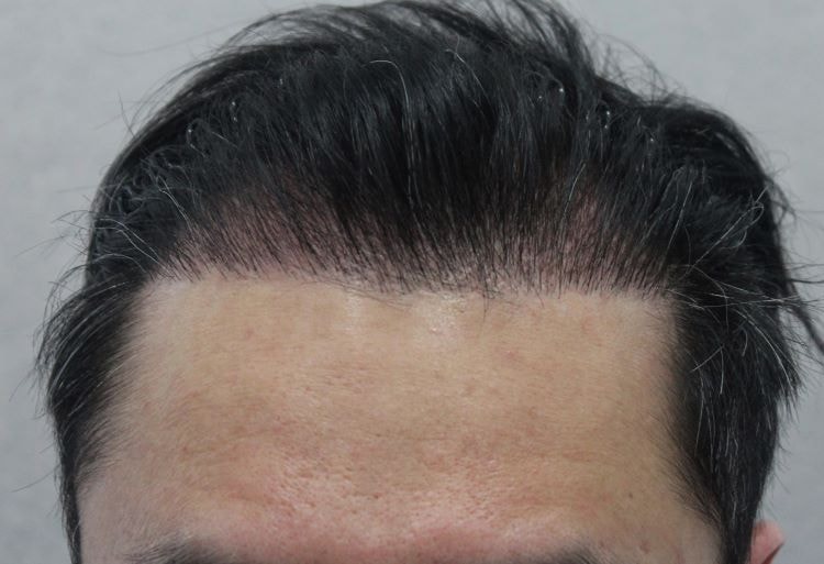 수술 3개월.jpg