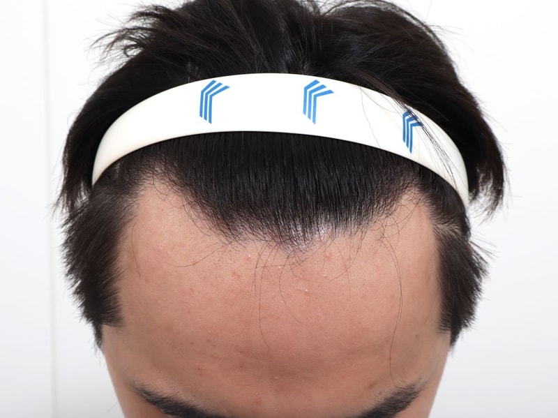 ★포헤어 부산점★ 비절개무삭발 슬릿 모발이식 2주차 후기