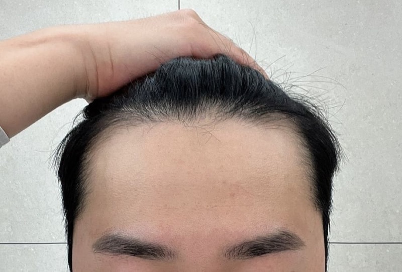울산남자의 모발이식 도전기 부산포헤어 비절개무삭발 슬릿이식 수술당일 후기