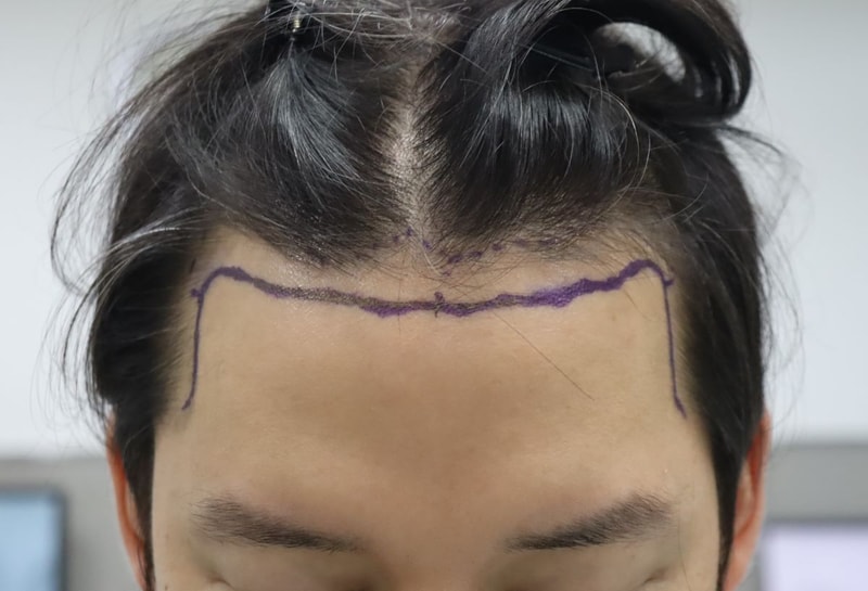 Pohair m-shaped hair loss ratio slit 1259 hair follicles 1 month late