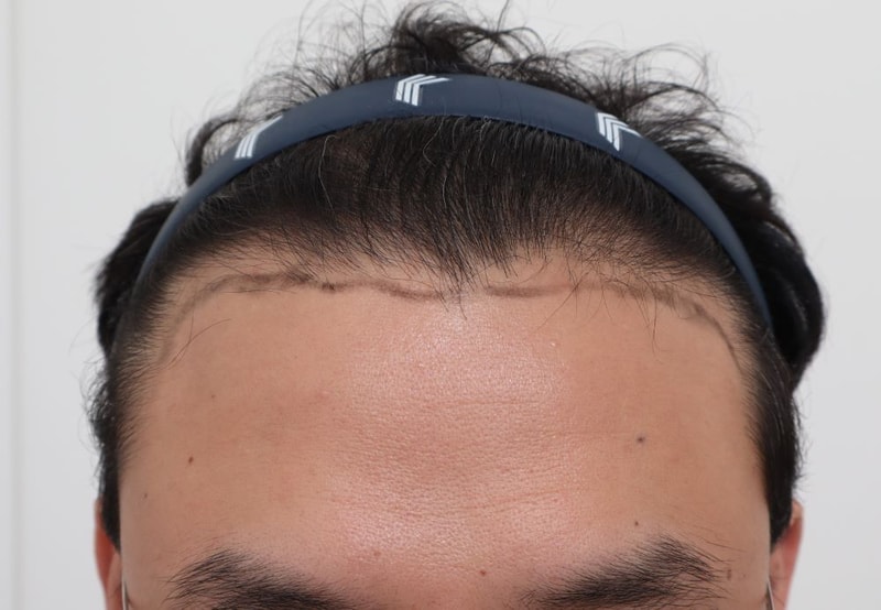 부산모발이식 서면 포헤어의원 비절개무삭발 슬릿이식 1467모낭 2주차 후기