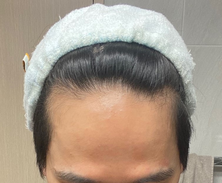 부산 비절개슬릿전문 포헤어의원 헤어라인내림 비절개모발이식 암흑기 후기