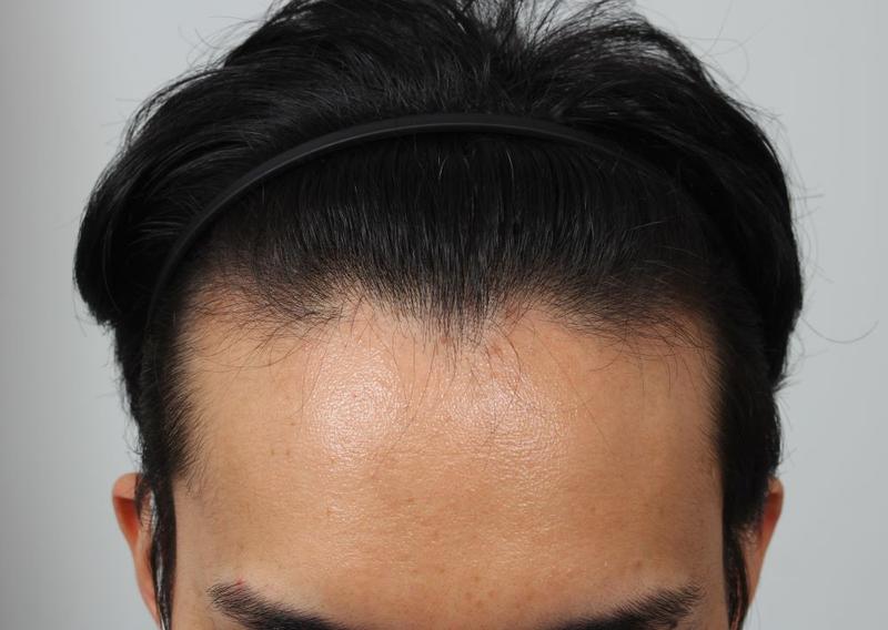 Completion of a slick hairline Busan For Hair Non-cut Hair Transplantation 9 months later