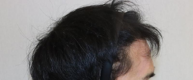 M-shaped hair loss ratio 3,800 Mo. It's been 9 months