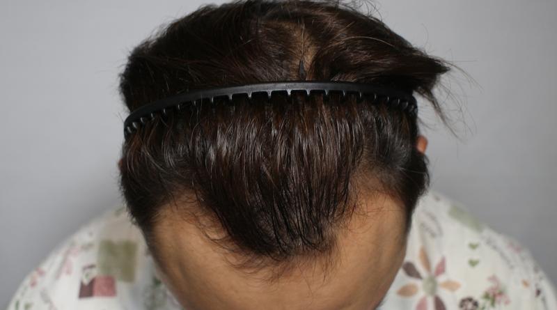 Hairline 4,000 hair transplant review
