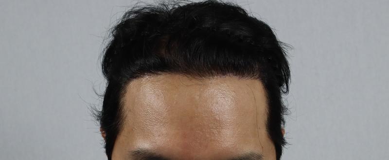 M字脱毛 鼻切開 3600毛 9ヶ月目のレビューです
