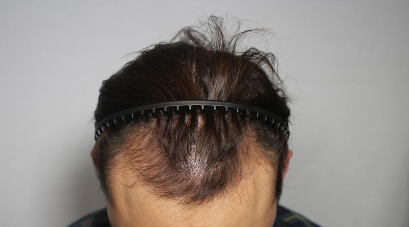 This is the review of hairline transplantation in Moaman Clinic for 3 months