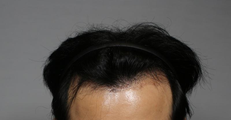 모발이식 1개월 차 절개흉터 거의 안보이네요