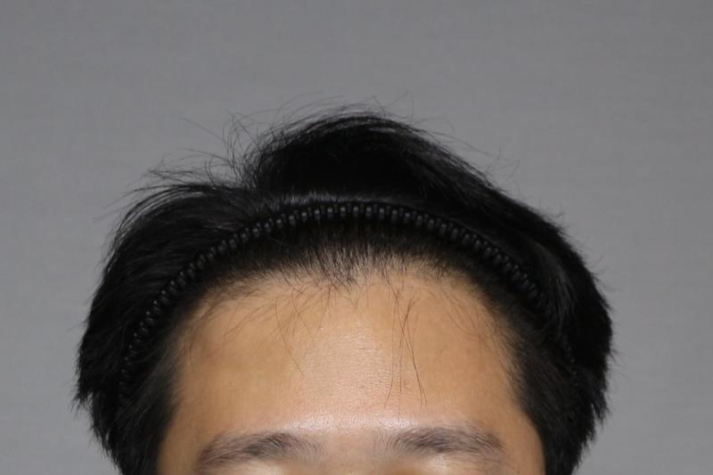 M자 탈모 모발이식 1개월차입니다 (절개 / 2500모)