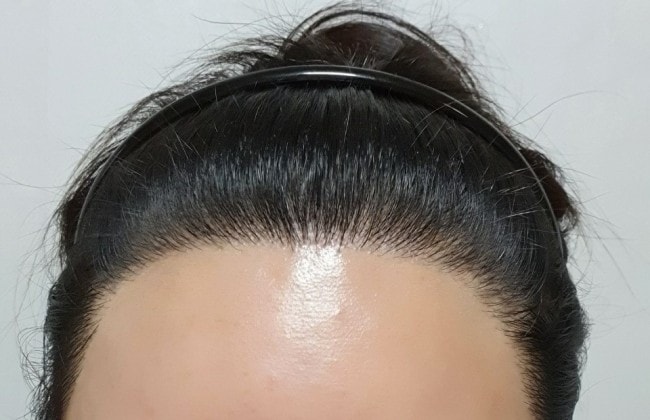 수술후2.jpg
