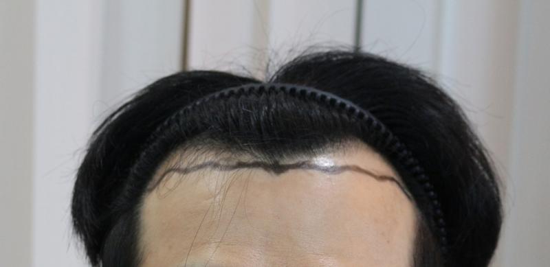 모발이식 잘선택한거같네요