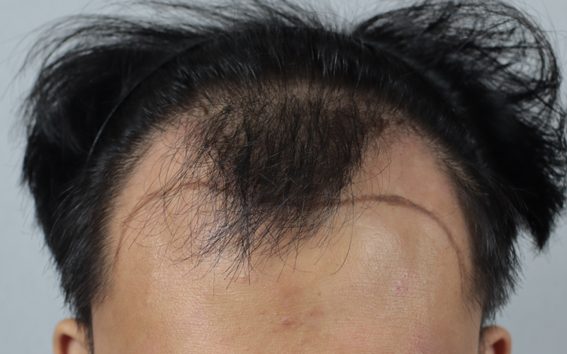M-shaped hair loss ratio 3800 Mo 5th month review!
