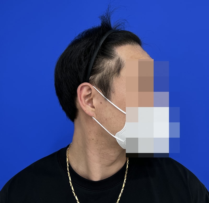 수술9m후 2 복사.jpg