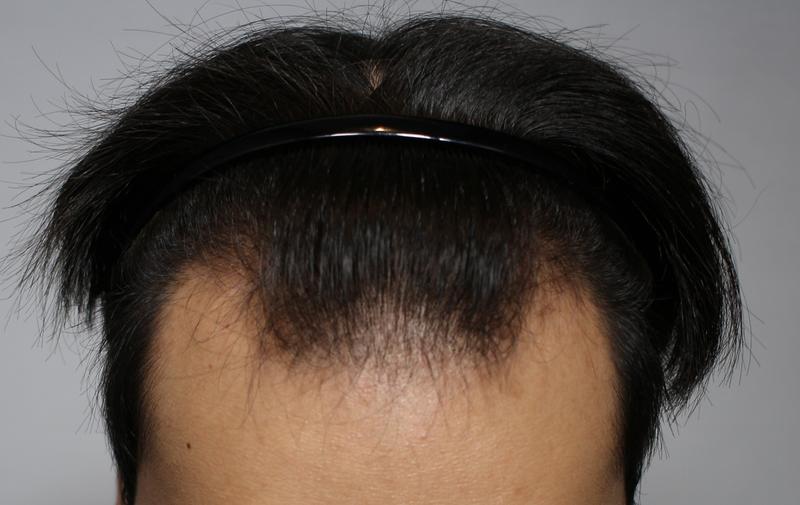 江南モアマン医院 ヘアライン、頭頂部切開 毛髪移植 5500毛 レビュー