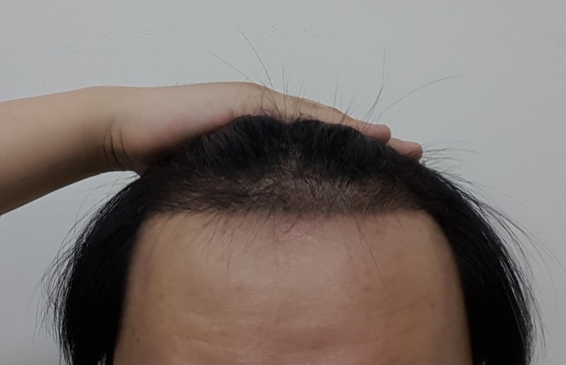 非切開1300毛包3ヶ月目です。
