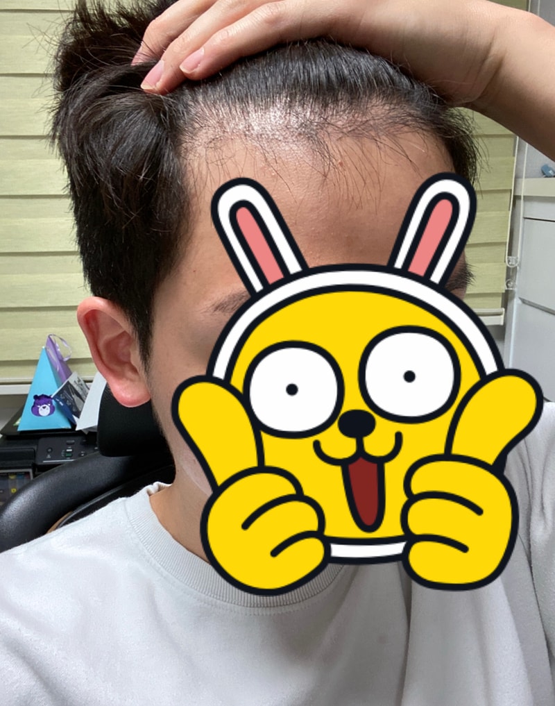 2달 경과 사진입니다