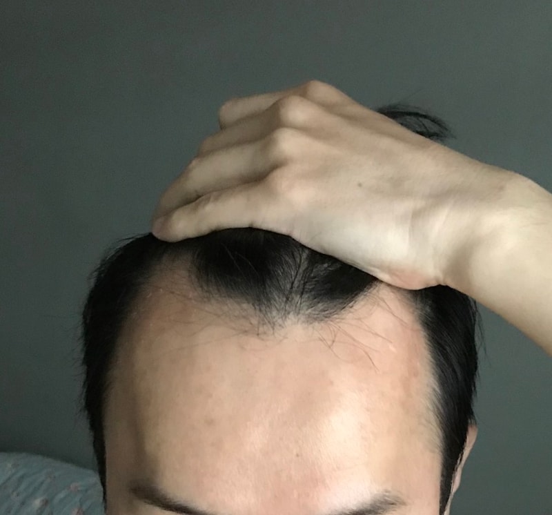 做了M字脱发手术。