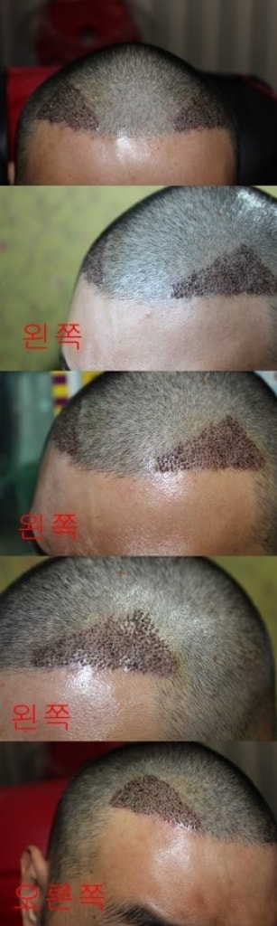 뉴헤어 이식한지 8일차 아침~~