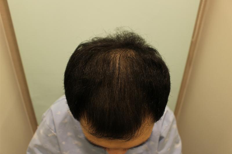 发际线、头顶集中强化密度结果