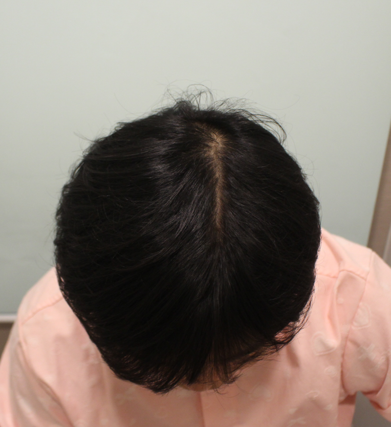 頭頂部、2ヵ月間暗黒期無事通過