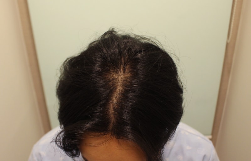 ヘアライン+分け目5ヶ月! (チャームドクター)
