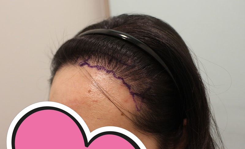 ヘアラインの片側の密度問題、チャームドクターで再手術