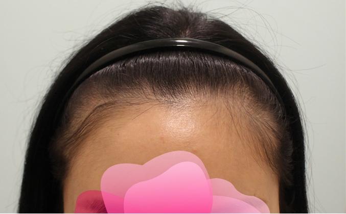 为了拥有光滑圆润的额头，接受了发际线矫正移植，