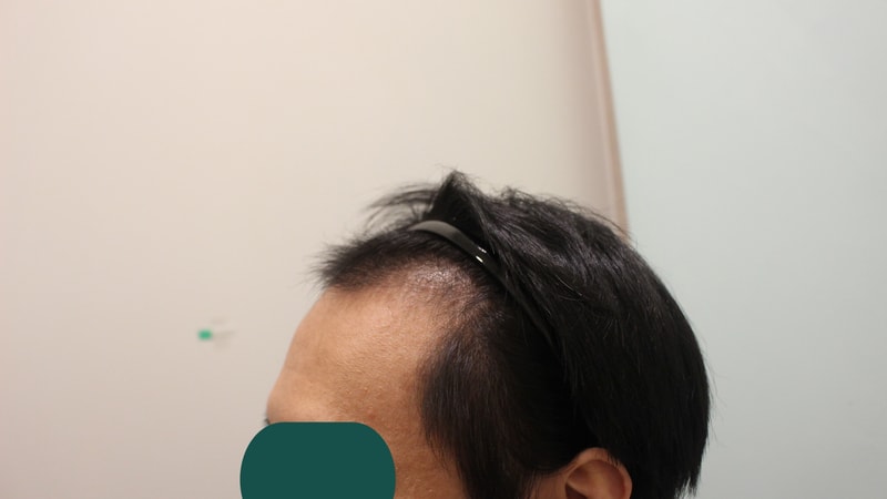 수술후 3개월 3.jpg