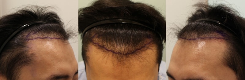 M자 헤어라인 모발이식 받고왔어요~