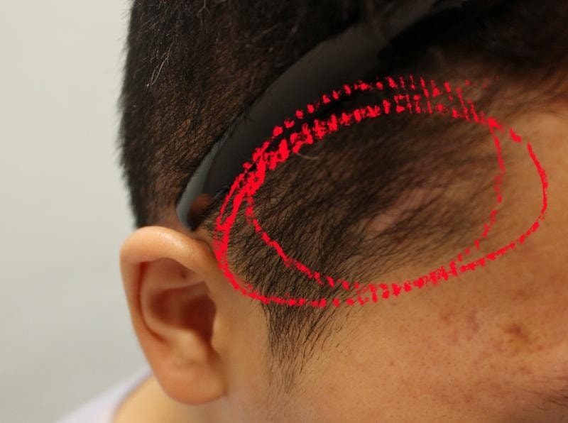 사고로 찍힌 머리흉터이식 세번째 경과